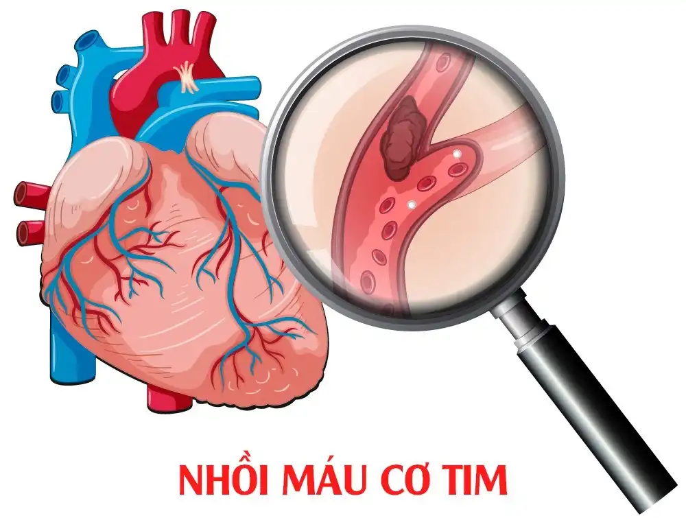 Nhồi máu cơ tim: Cảnh báo nguy hiểm từ cơn đau ngực tưởng như bình thường